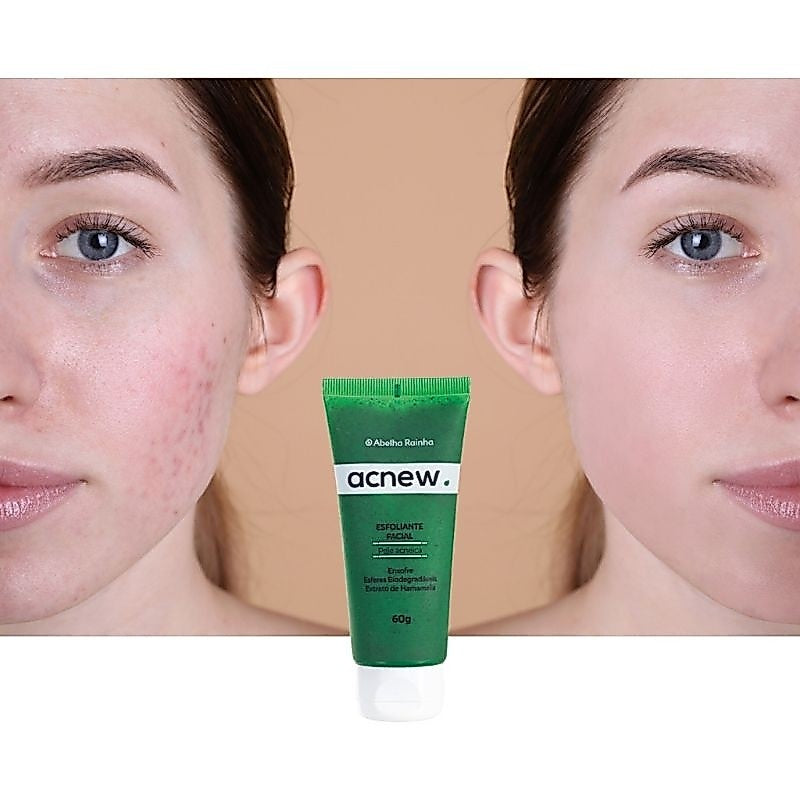 Acnew Esfoliante Facial – Abelha Rainha